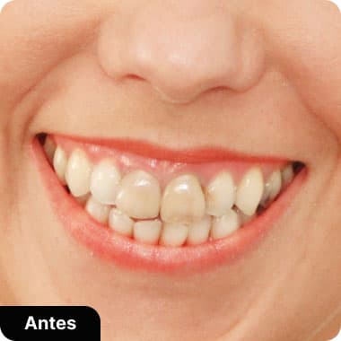 Lentes de Contado de porcelanda