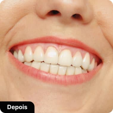 Lentes de Contado de porcelanda