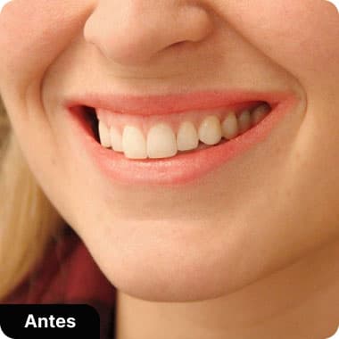 Lentes de Contado de porcelanda