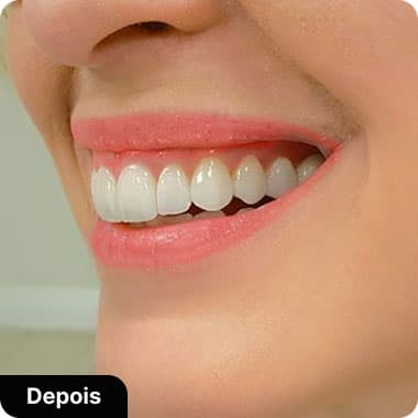 Lentes de Contado de porcelanda