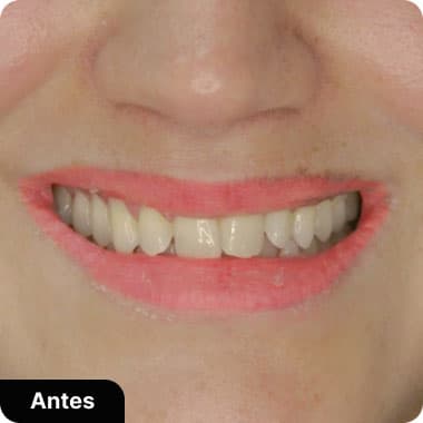 Lentes de Contado de porcelanda